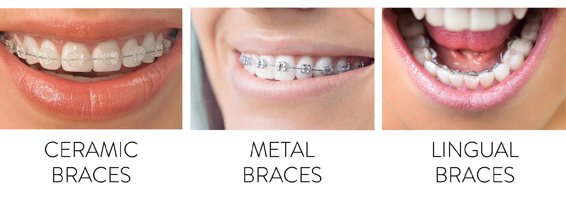 Types of Dental Braces